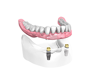 Protheses-supra-implantaire-amovible